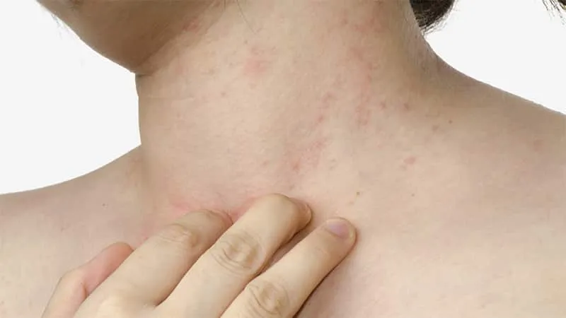 Can carrot allergies occur, how do they manifest, and how are they treated?